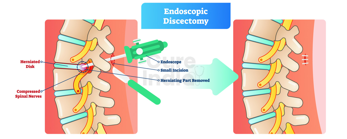 Endoscopic Decompression